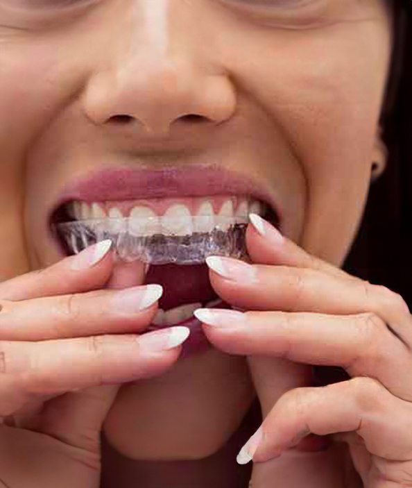 Diş Teli İstemeyenler İçin Şeffaf Plak Tedavisi