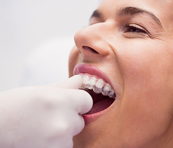 Şeffaf Plak Ortodonti Tedavisi (Invisalign) Hakkında Merak Edilenler…